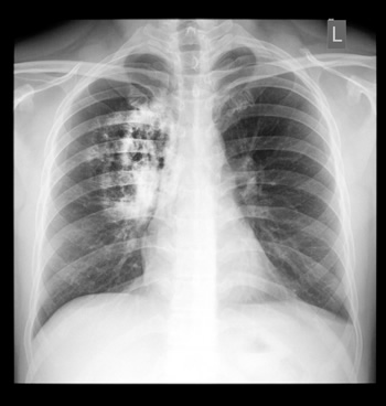 Lung Cancer Lung Cancer