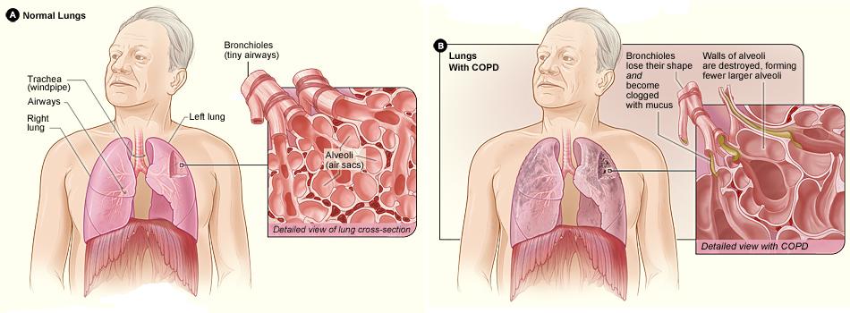 Lung Reduction Diagram