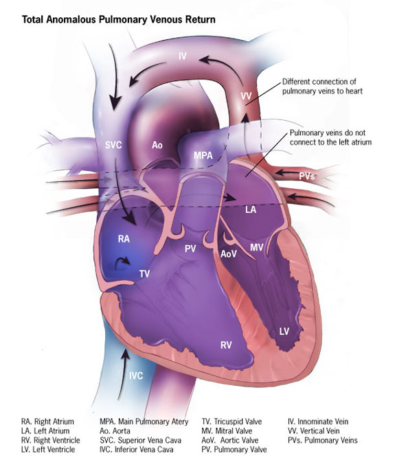 Total Anomalous Pulmonary Venous Return (TAPVR) TAPVR