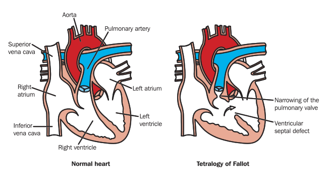 Tetralogy of Fallot Tetralogy of Fallot
