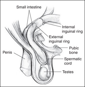 Inguinal Hernia
