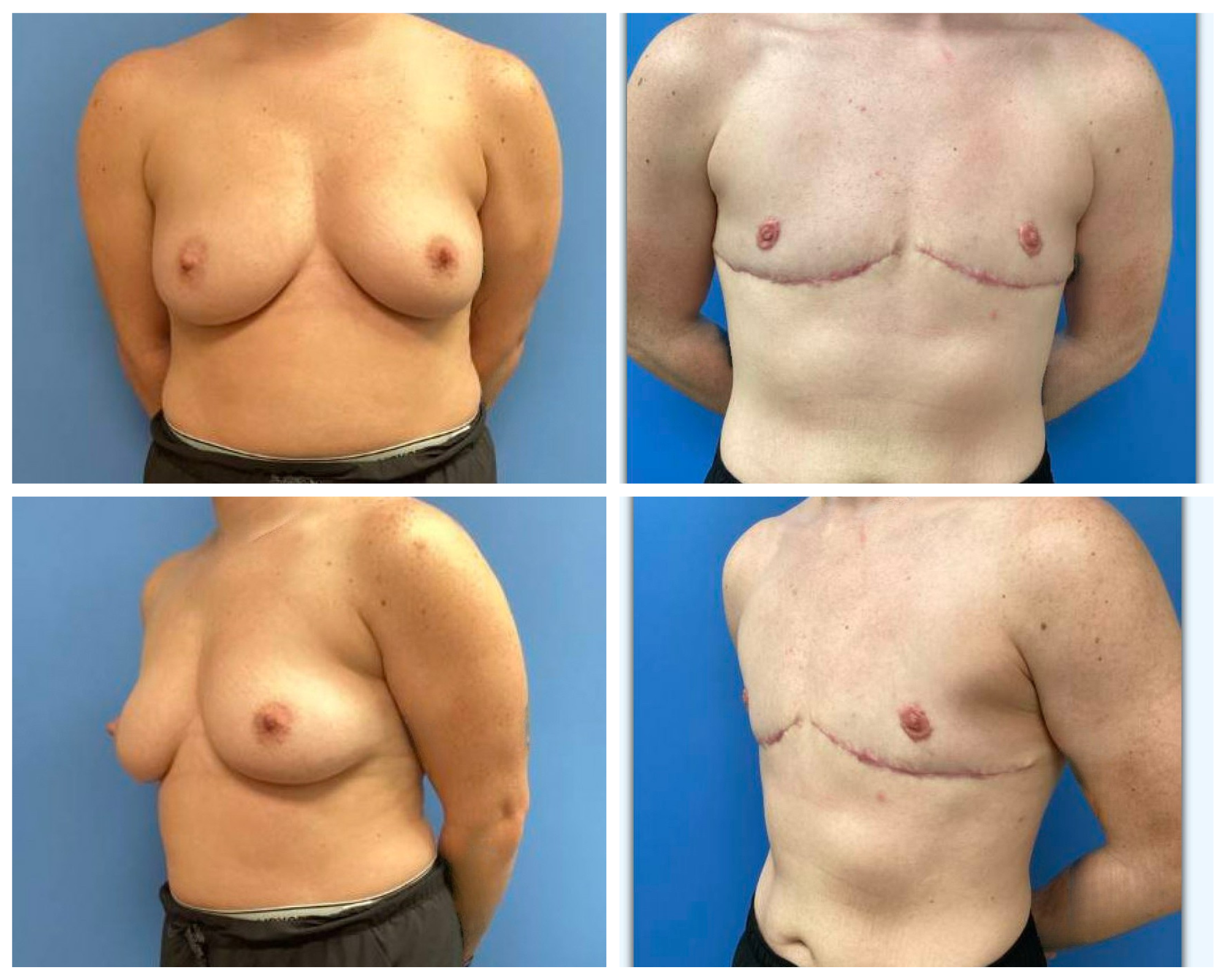Before and After