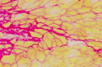 Fibrosis