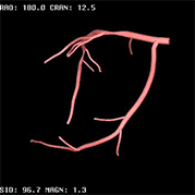 PCI-3D-Coronary-3 PCI-3D-Coronary-3