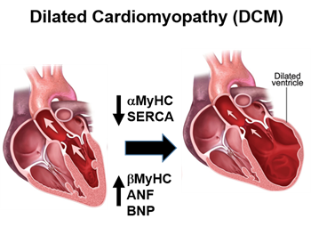 Pediatric Dilated Cardiomyopathy