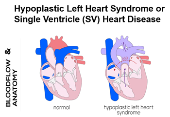 Single Ventricle Heart Disease
