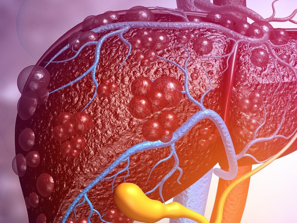 Fatty Liver