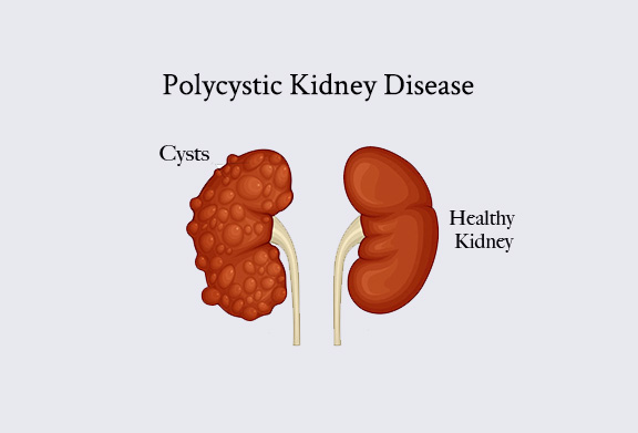 polycystic kidney disease