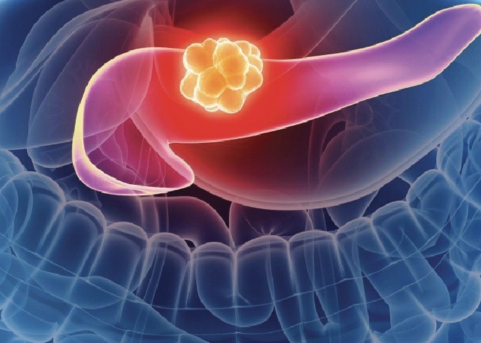 Pancreatic Cancer